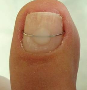 Veertjes, (spanners) voor nagelregulatie